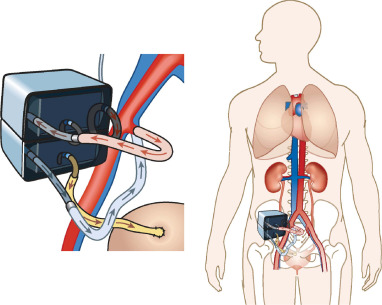 Implantable Artificial Kidney: A radical breakthrough in Kidney Transplant